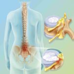 Причины появления грыжи межпозвоночного диска