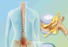 Причины появления грыжи межпозвоночного диска