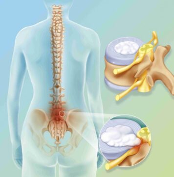 Причины появления грыжи межпозвоночного диска