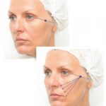 Контурная пластика лица: какие зоны подлежат коррекции?