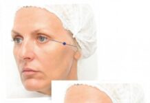 Контурная пластика лица: какие зоны подлежат коррекции?