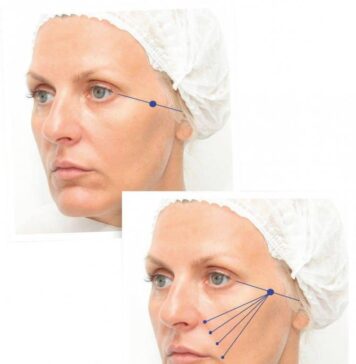 Контурная пластика лица: какие зоны подлежат коррекции?