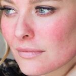 Причины появления розацеа