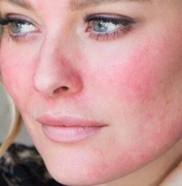 Причины появления розацеа