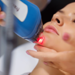 Особенности лазерного лечения акне