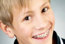Какие брекеты лучше выбрать ребенку?