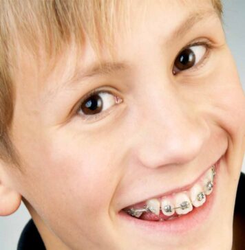 Какие брекеты лучше выбрать ребенку?