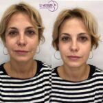 СМАС-лифтинг: эффективная альтернатива пластической хирургии