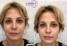СМАС-лифтинг: эффективная альтернатива пластической хирургии