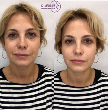 СМАС-лифтинг: эффективная альтернатива пластической хирургии