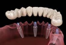 Виды имплантации зубов