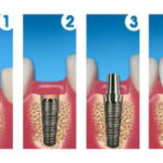 Этапы имплантации зубов: как происходит установка импланта?