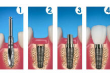 Этапы имплантации зубов: как происходит установка импланта?