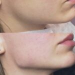 Контурная пластика углов нижней челюсти