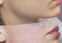 Контурная пластика углов нижней челюсти