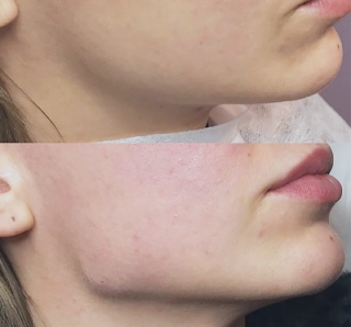 Контурная пластика углов нижней челюсти