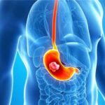 Показания к проведению эндоскопической гастростомии