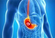 Показания к проведению эндоскопической гастростомии