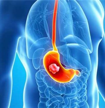 Показания к проведению эндоскопической гастростомии