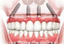 Технология и особенности имплантации методом All-on-4