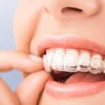 Элайнеры для зубов: особенности использования