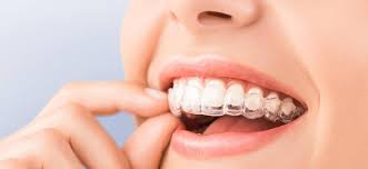Элайнеры для зубов: особенности использования