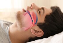 Лечение храпа