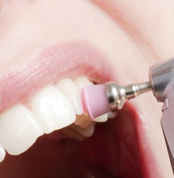 Что представляет собой ультразвуковая чистка зубов?