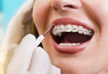 Как работают брекеты для выравнивания зубов?