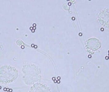 МАР-Тест: революционная диагностика в борьбе с бесплодием