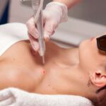 Удаление папиллом методом деструкции: исцеляющие шаги в уходе за кожей