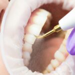 Ультразвуковая чистка зубов: эффективность и преимущества перед традиционными методами