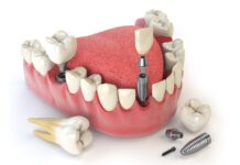 Этапы протезирования зубов в Китае