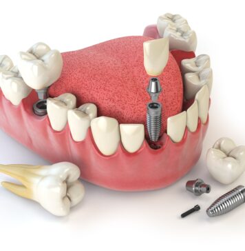Этапы протезирования зубов в Китае