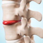 Как можно эффективно вылечить грыжу позвоночника без операции?