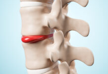 Как можно эффективно вылечить грыжу позвоночника без операции?