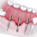 В чем отличие базальной имплантации от обычной?
