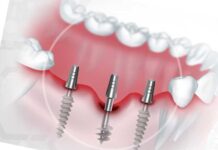 В чем отличие базальной имплантации от обычной?