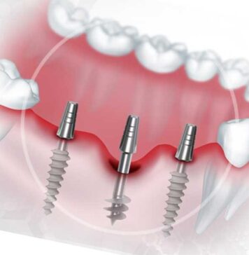 В чем отличие базальной имплантации от обычной?