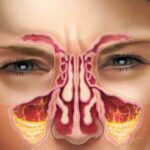 Симптомы острого синусита