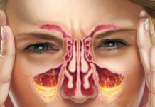 Симптомы острого синусита