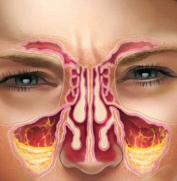 Симптомы острого синусита