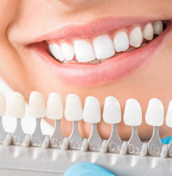 Разновидности материалов для коронок и виниров: какой выбрать?