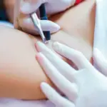 Особенности электроэпиляции