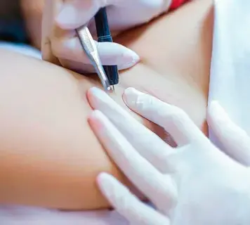 Особенности электроэпиляции