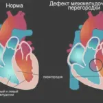 Что такое дефект межжелудочковой перегородки