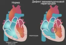 Что такое дефект межжелудочковой перегородки