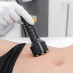 RF-лифтинг живота