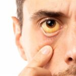 Как жить с синдромом Жильбера и не испытывать симптомов