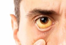 Как жить с синдромом Жильбера и не испытывать симптомов